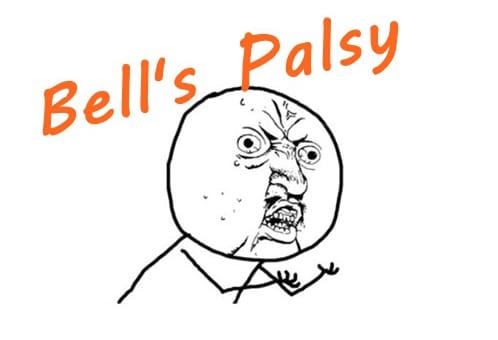 面瘫Bell’s Palsy