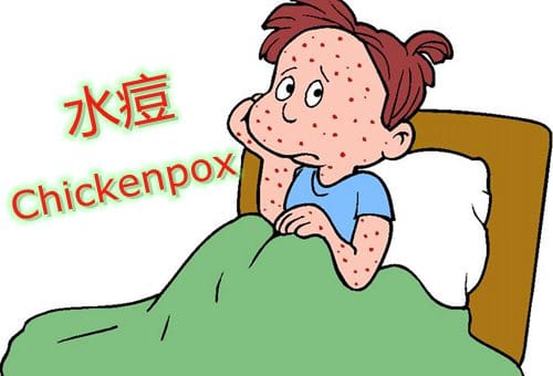 新西兰儿童传染病水痘Chickenpox