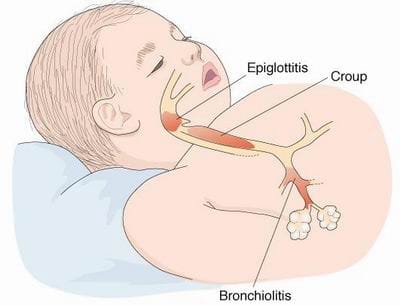 新西兰幼儿常见疾病哮吼Croup